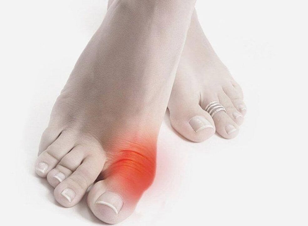 gouty foot symptoms